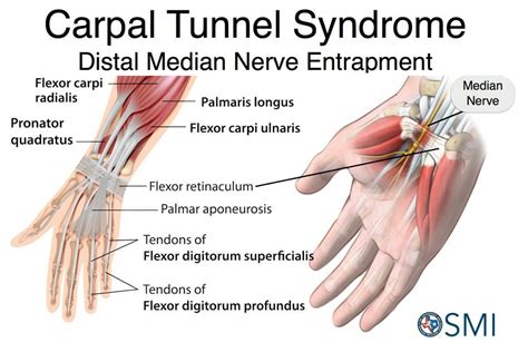 Carpal Tunnel syndrome: Avoid Surgery - PhysioPrescription