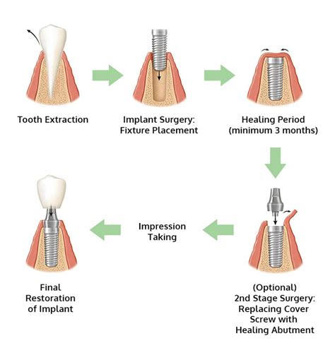 What Are Dental Implants and Am I Suitable for Them? - Medisave-Claimable - Twinkle Family ...