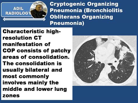 CRYPTOGENIC ORGANIZING PNEUMONIA... - Radiology Classroom