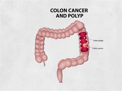 Polypectomy Procedure Cape Town | Gastric Polyp Removal