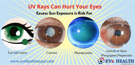 What Are The Ultraviolet Rays? Beneficial And Harmful Effects Of UV Rays - Eye Health Nepal