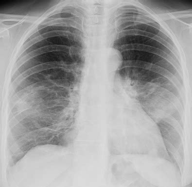 Cryptogenic Organizing Pneumonia/Secondary Organizing Pneumonia | Radiology Key