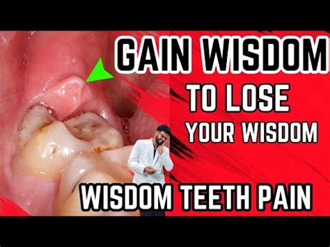 How To Help Wisdom Tooth Pain - Askexcitement5