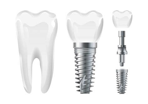 Types of Dental Implants | Dr. Mahsa Esfandiari Dental Group