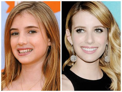 10 Celebrities with Veneers Before and After | Dentgap