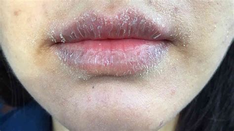 Upper Lip Swelling Food Allergy | Sitelip.org