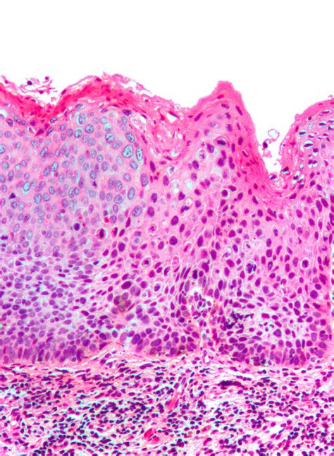 Vulvar intraepithelial neoplasia - Wikipedia