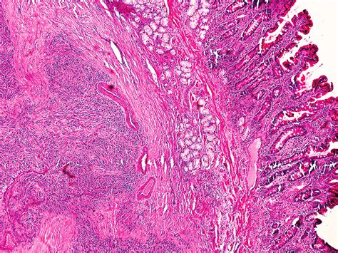 Duodenal GIST histology. H + E staining. Magnification 100× | Download ...