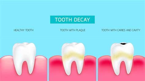 Do You Have Tooth Decay? Here's 5 Signs That You Might