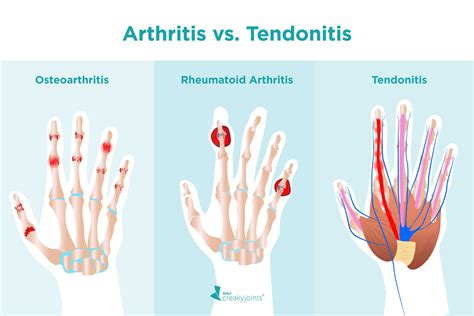 Diferencias Entre Tendinitis Y Tendinosis | Porn Sex Picture