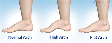 Flat feet vs High foot arch - Mandurah Physiotherapy