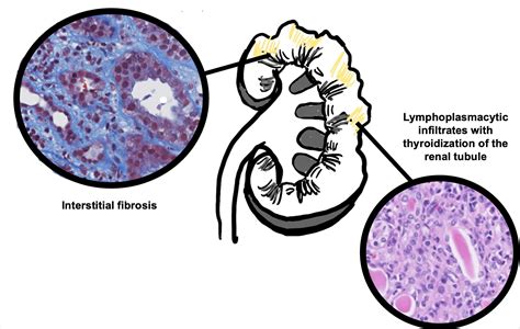 Acute Pyelonephritis