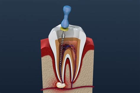 Step-by-step Guide to a Root Canal Procedure - Hudson Family Dental Grand Junction Colorado