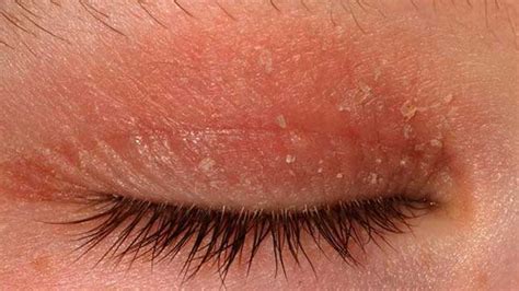 Eczema Around the Eyes: Treatment and More