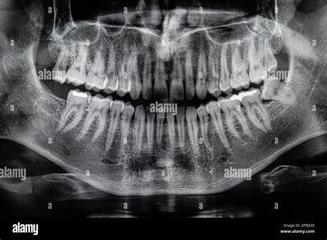 Orthopantomography, OPG X-ray DR digital wisdom teeth. panoramic film x ...