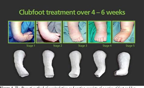 Congenital Clubfoot Surgery