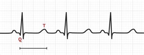 QT Prolongation | Test Findings - MedSchool