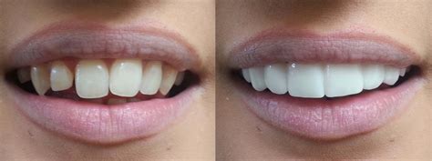 Press On Veneers - The Dental Guide