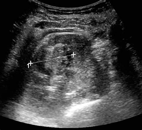 Kidney Tumor Ultrasound