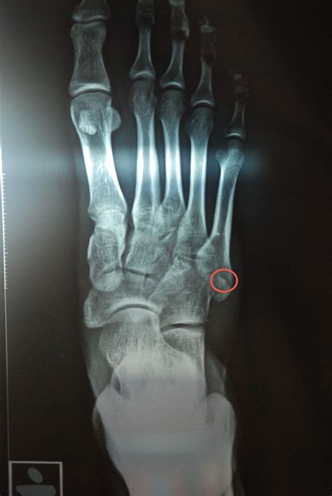 5th Metatarsal Fracture - Fracture Treatment