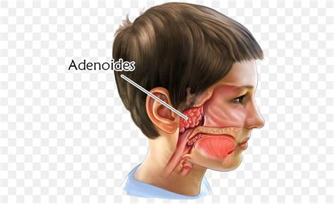 Adenoid Tonsillectomy Surgery Tonsillitis, PNG, 500x502px, Adenoid, Adenoidectomy, Cheek, Child ...