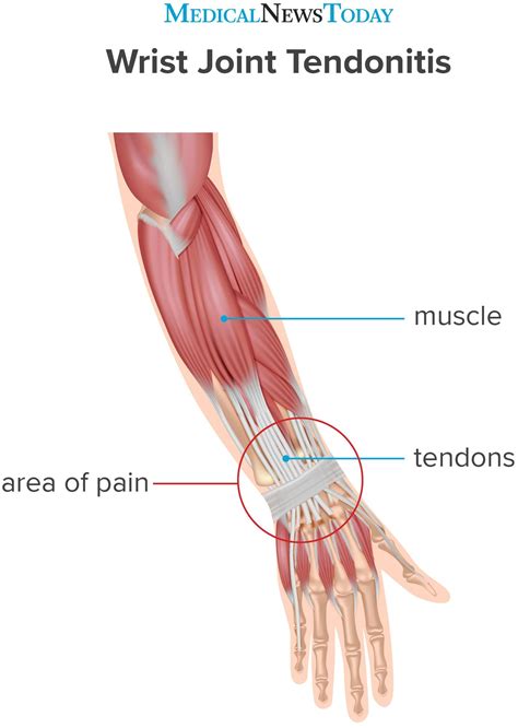 Wonderful Info About How To Recover From Tendonitis - Strangertourist2