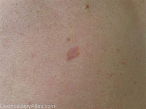 pictures of melanoma on leg - pictures, photos