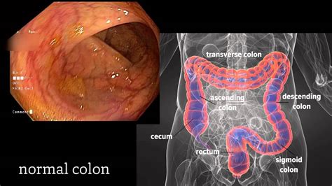 Colonoscopy: A Journey Though the Colon and Removal of Polyps - YouTube