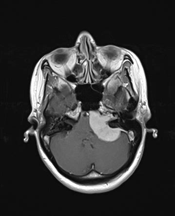 Petroclival meningioma | Radiology Case | Radiopaedia.org