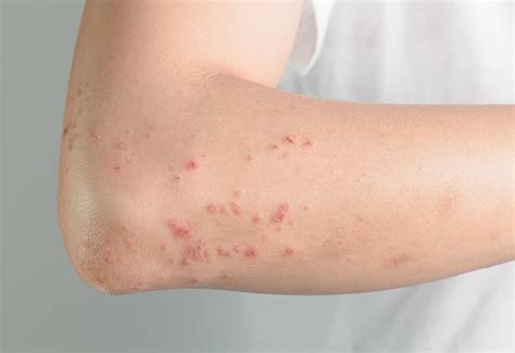 Hives From Pregnancy: Reasons, Signs & Treatment