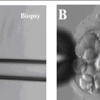 Blastomere biopsy ×200. (A) Blastomere biopsy; (B) A blastomere with ...