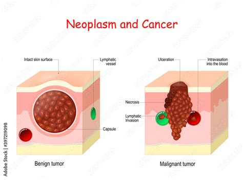 Cancer and Neoplasm. comparison and difference between Malignant and Benign tumor Stock Vector ...