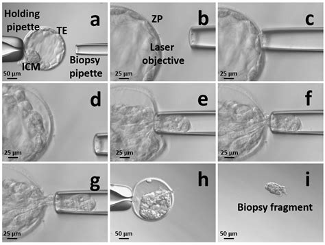 Human Blastocyst Biopsy and Vitrification (article) | JoVE