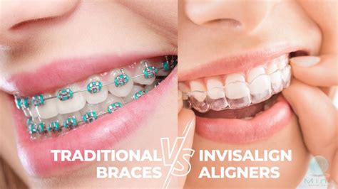 A Close Look: Traditional braces vs Invisalign aligners - Mint Dentals Care