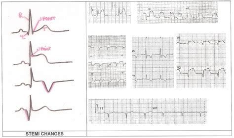 More Instructor Resources | Page 2 | ECG Guru - Instructor Resources