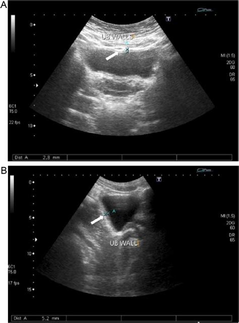 (A) An ultrasound image of the urinary bladder (transverse scan)... | Download Scientific Diagram