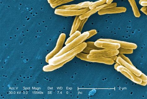 Tuberculosis