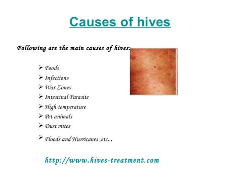 Hives treatment