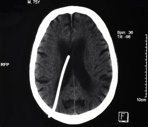 Ventriculoperitoneal Shunt Complications