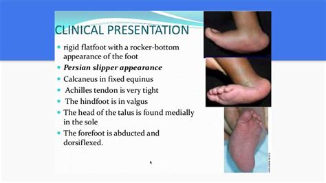 Congenital Vertical Talus for medical students - YouTube