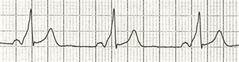 PR Interval • LITFL • ECG Library Basics