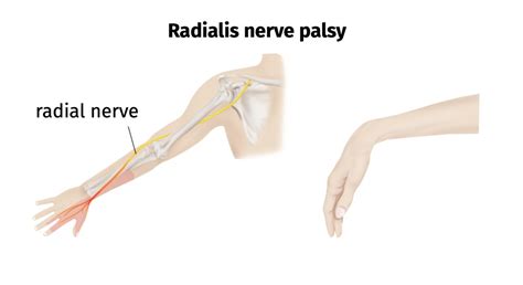 Radial nerve palsy