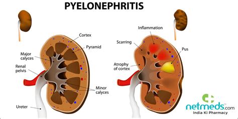 Pyelonephritis