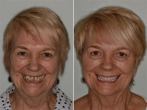 All-on-4 ® Dental Implants Photos | Miami, FL