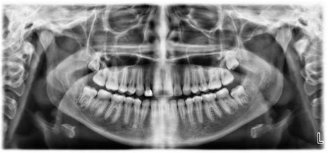 Dental Xrays & OPG Malvern - General & Specialist Dentist | Melbourne