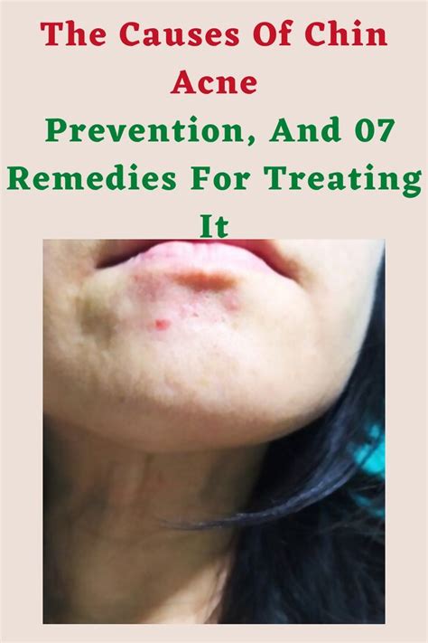 The Causes Of Chin Acne, Prevention, And 07 Remedies For Treating It | Chin acne, Chin acne ...