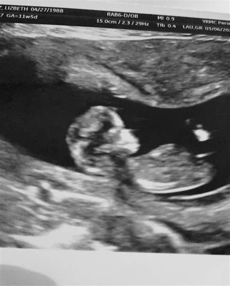 baby ultrasound pictures 12 weeks - Cyndy Kimmel