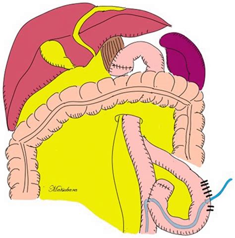 Surgical schema of jejunostomy feeding tube. A jejunostomy feeding tube... | Download Scientific ...