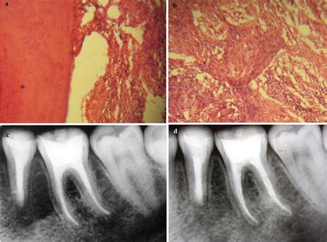 Periapical Cyst Histology