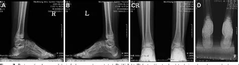 Figure 1 from Treatment of Calcaneovalgus Deformity Following Operative Treatment of Diplegic ...